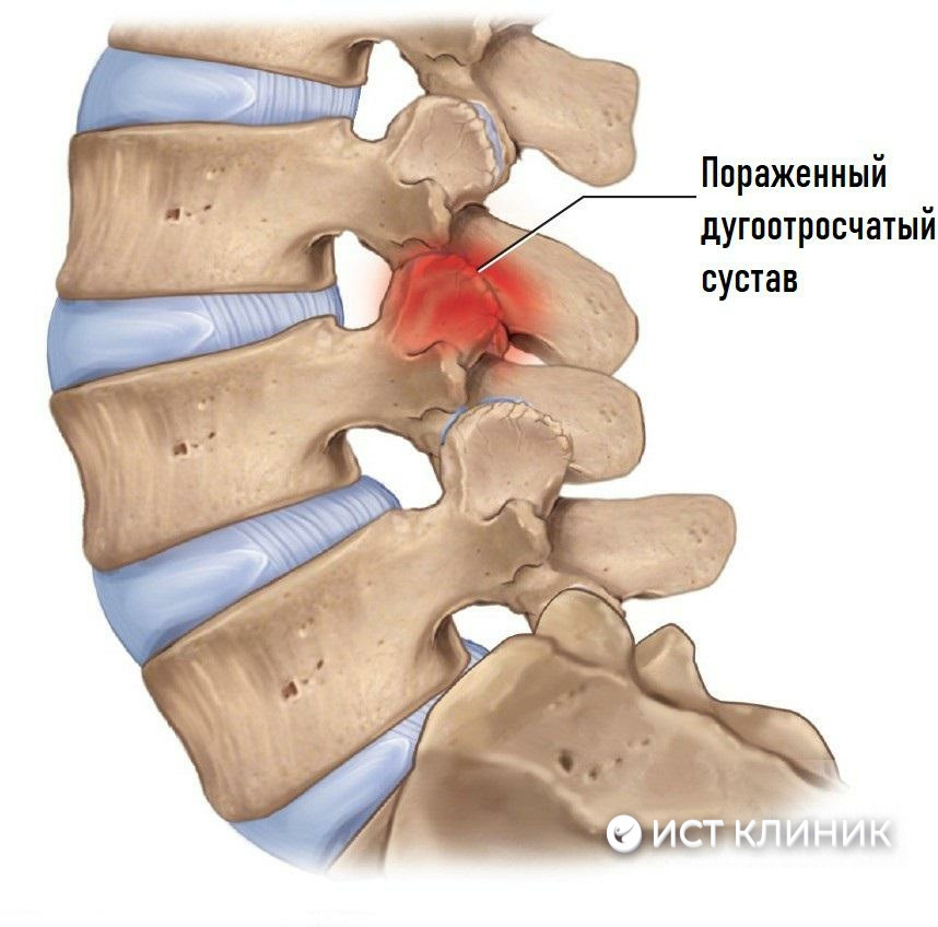 Лечение артроза в грудном отделе позвоночника в Ист Клиник