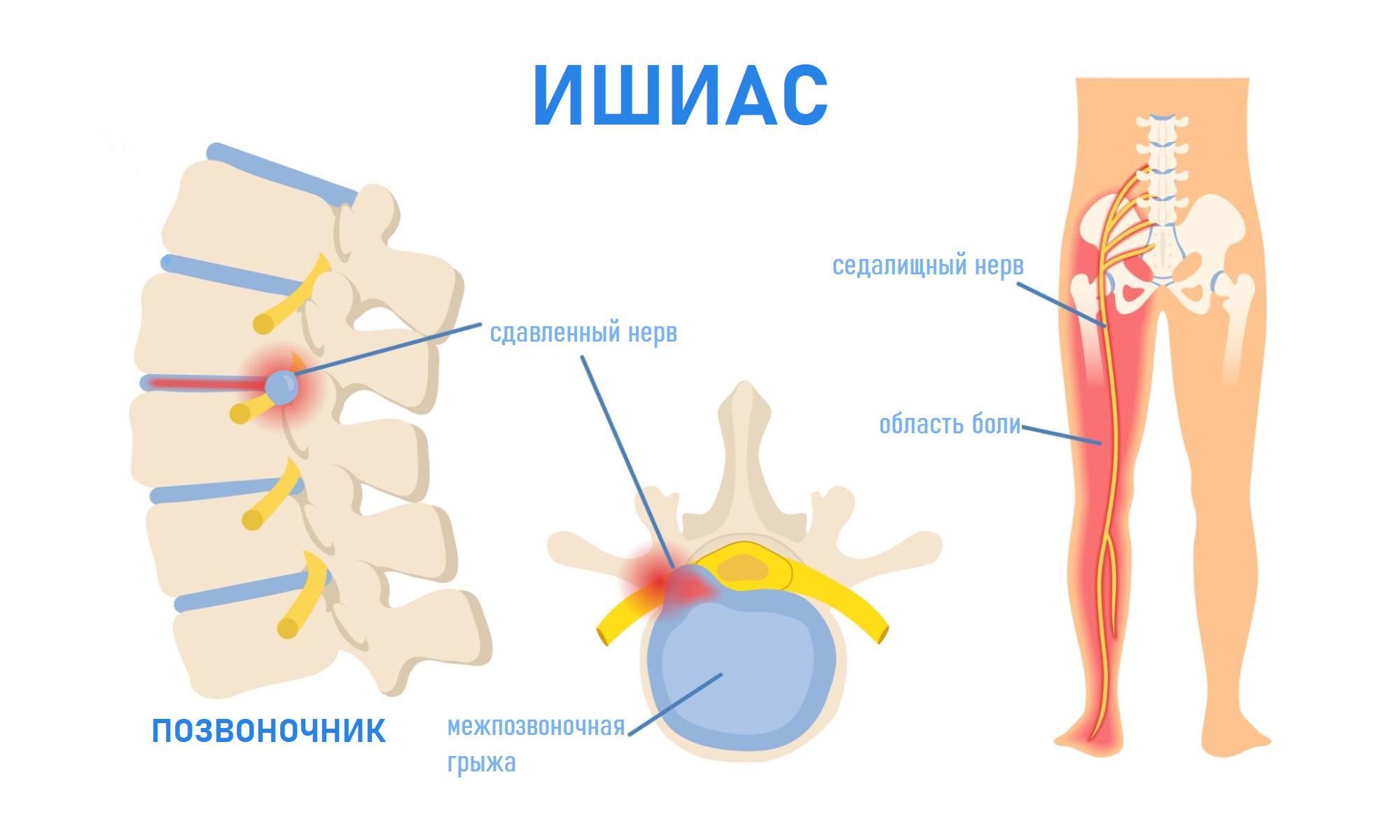 Ишиас — это боль по ходу седалищного нерва