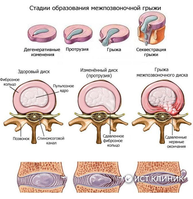 Лечение межпозвоночной грыжи в Ист Клиник, Москва