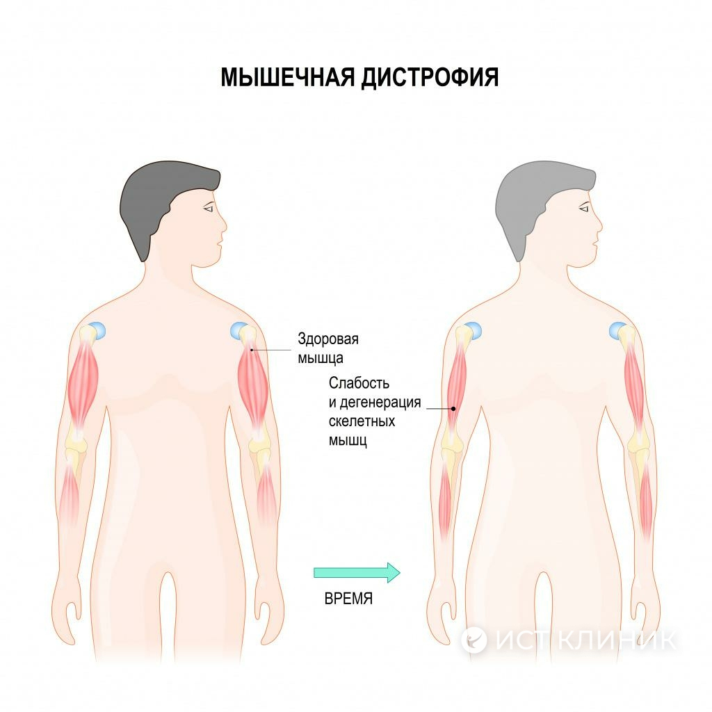 Лечение миопатии в Ист Клиник