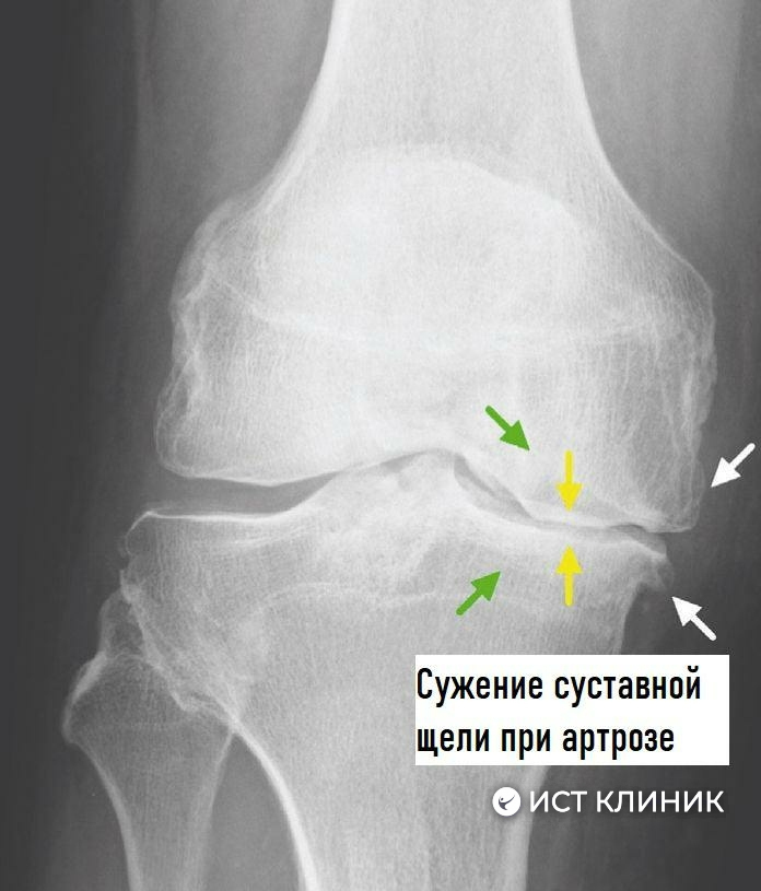 Лечение полиартроза в Ист Клиник, Москва