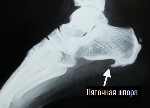 Пяточная шпора — это окостенение сухожилия подошвенной мышцы