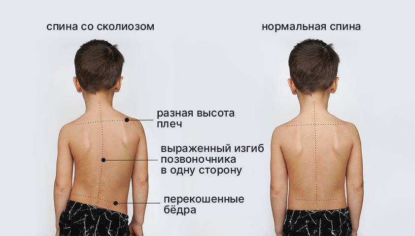 Сколиоз у ребенка - лечение в Ист Клиник, Москва
