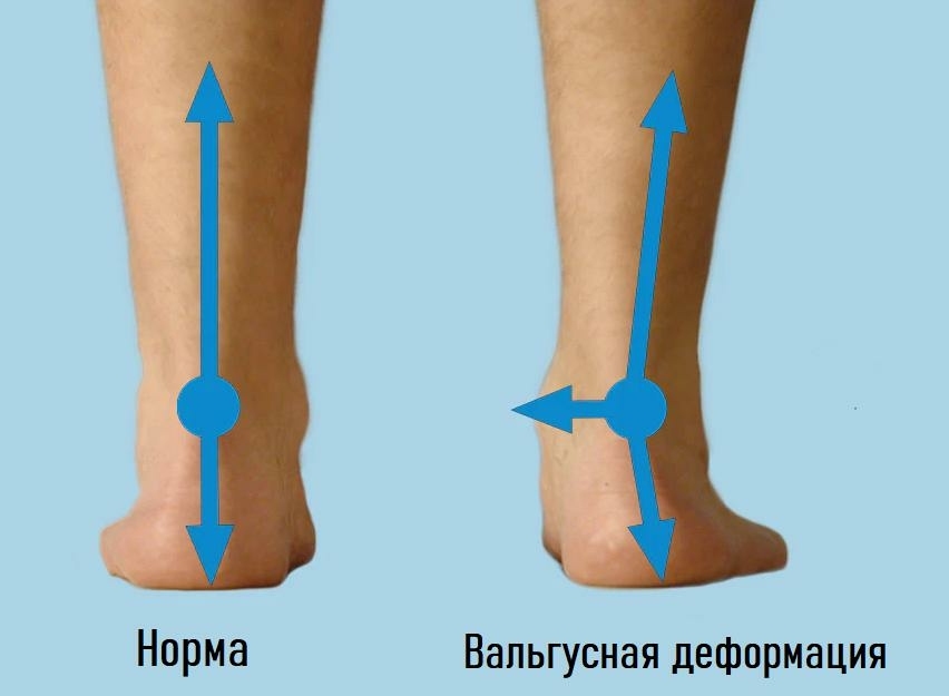 Вальгусная деформация стопы - лечение в Ист Клиник, Москва