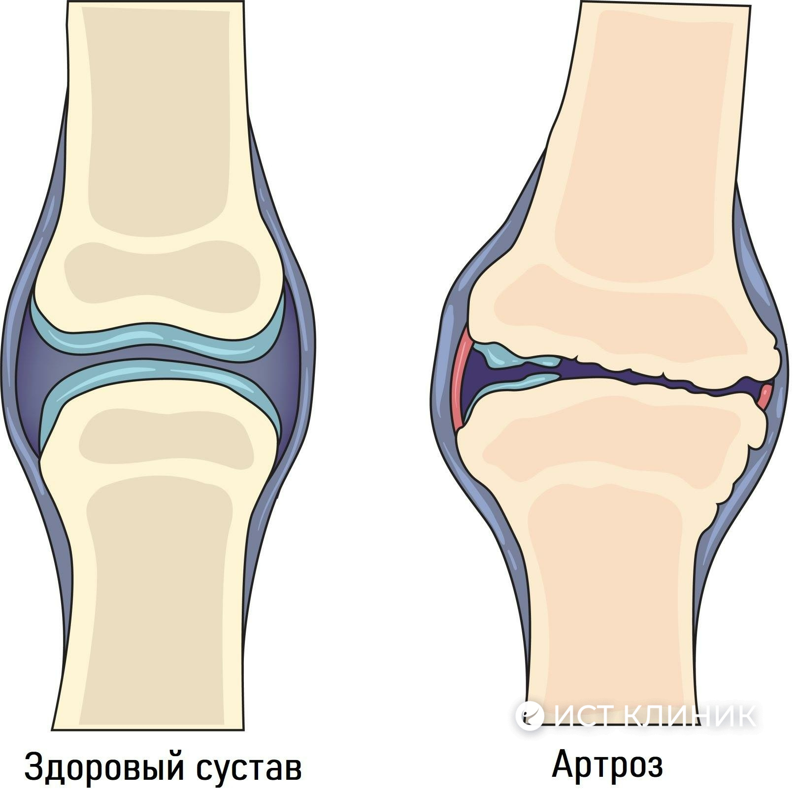 Причины артроз суставов