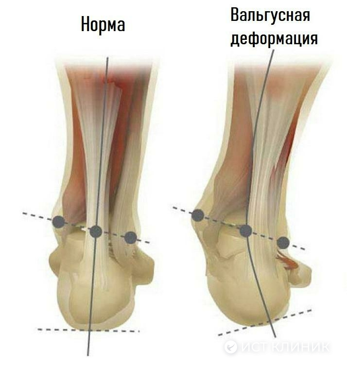 Вальгус стопы