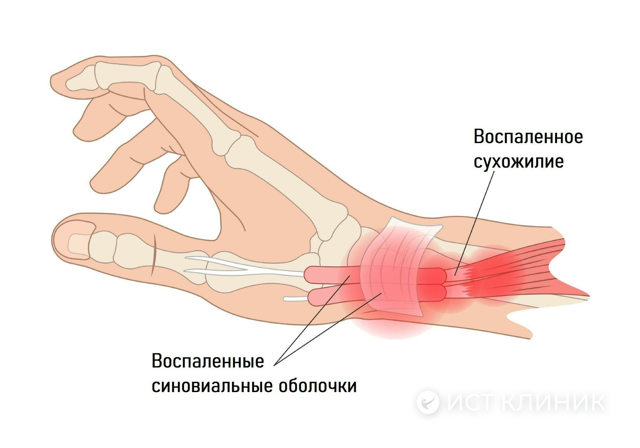 Теносиновит сухожилия - лечение в Ист Клиник