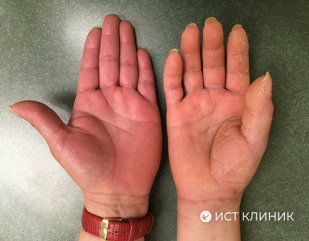 Лечение синдрома Зудека лучезапястного сустава в Ист Клиник