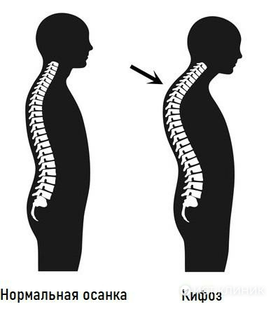 Кифоз грудного отдела позвоночника